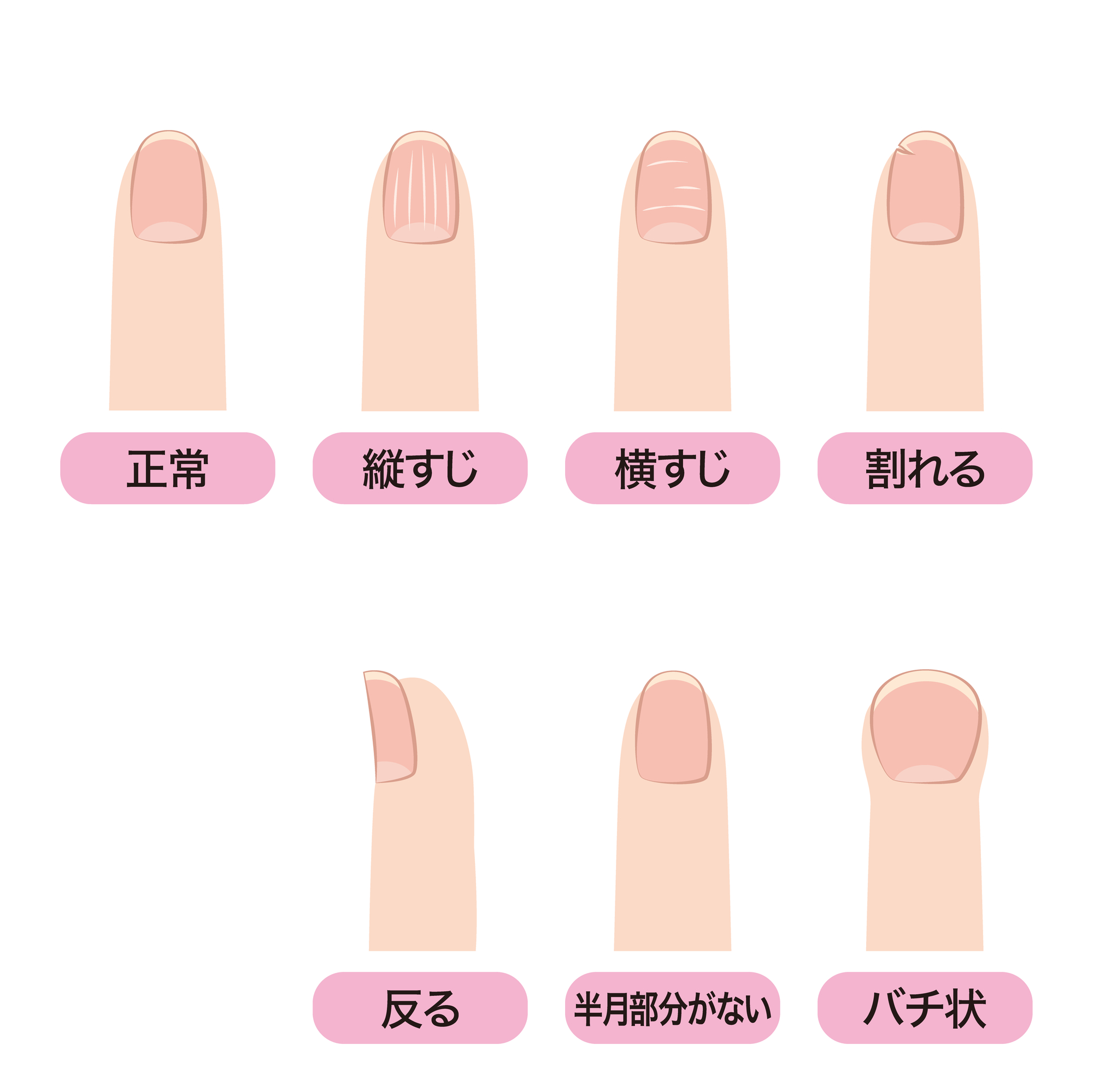 爪から判るからだの状態（爪の形） ｜ 神奈川県横浜市の漢方薬局 回徳堂薬局